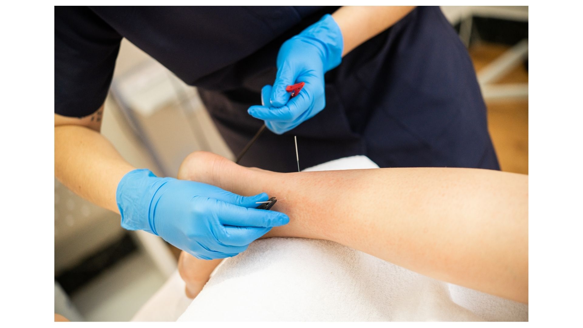 Acupuncture Alternatives: Is It Right for You?
