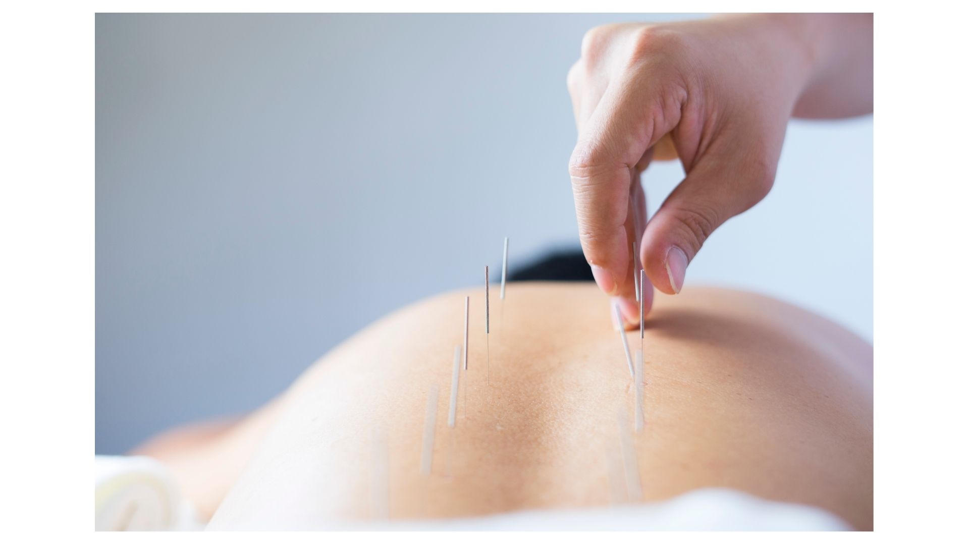 Does Insurance Cover Acupuncture?
