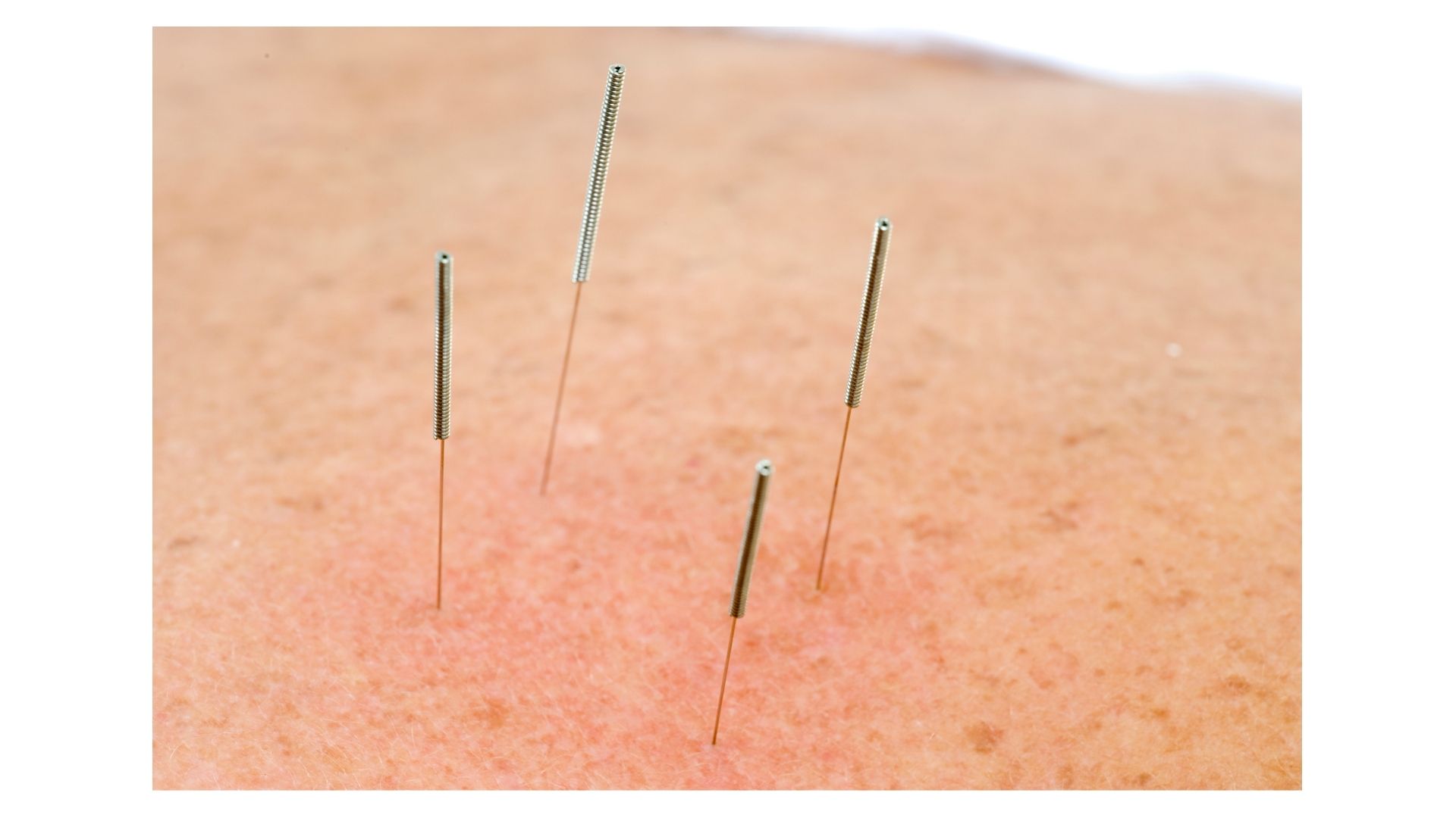 Acupuncture Explained: How Does It Actually Work?